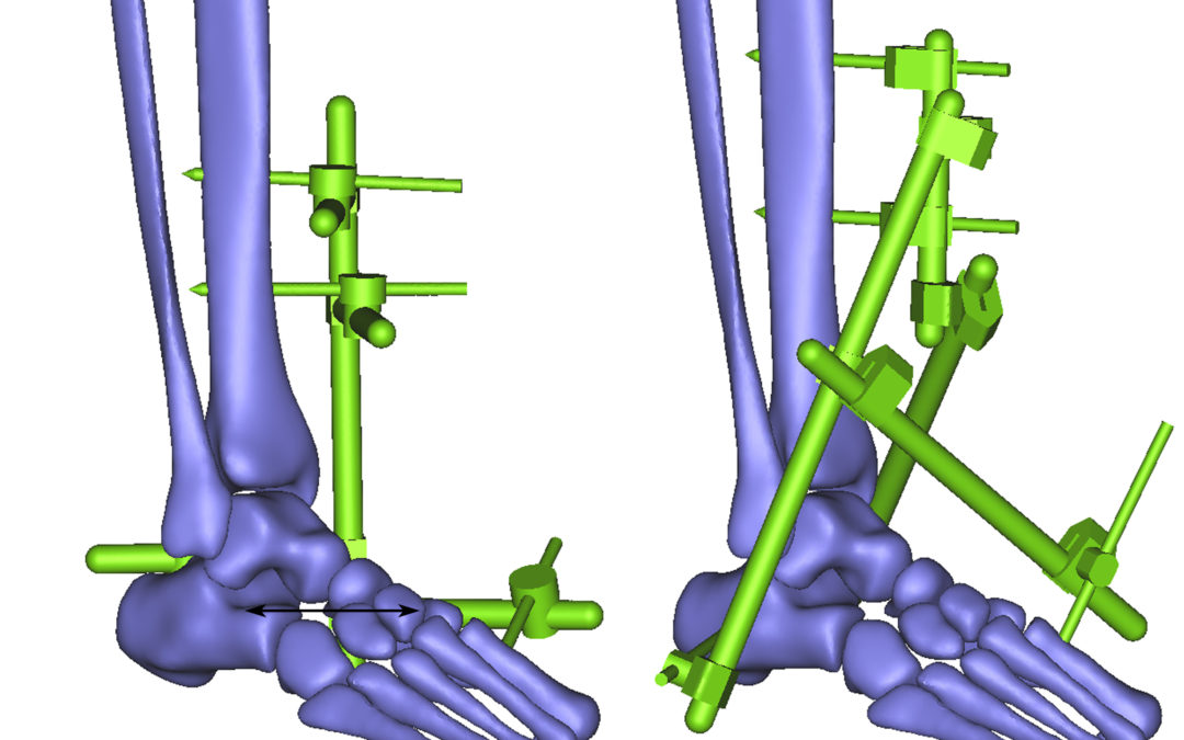 The Important of External Fixator Choices in Treating Bone Fracture