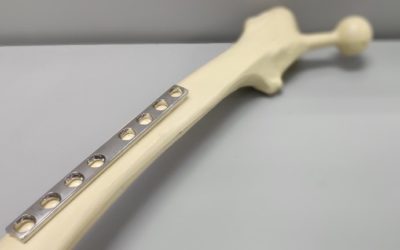 No More Second Surgery Needed for Bone Implant: Is It Possible?